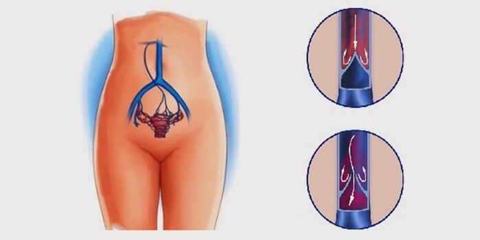 Kodėl atsiranda dubens venų varikozė