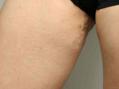 dubens venų varikozė nėštumo metu